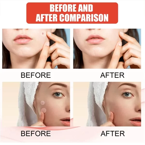144pcs Face Acne Patch Invisible Skin Care Pimple Acne Patches Anti-inflammatory Healing Absorbing Spot Sticker Covering Acne - Image 5